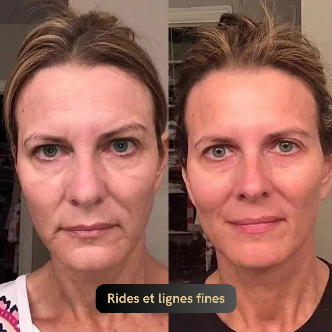 Vitagen® Système Micro-Infusion