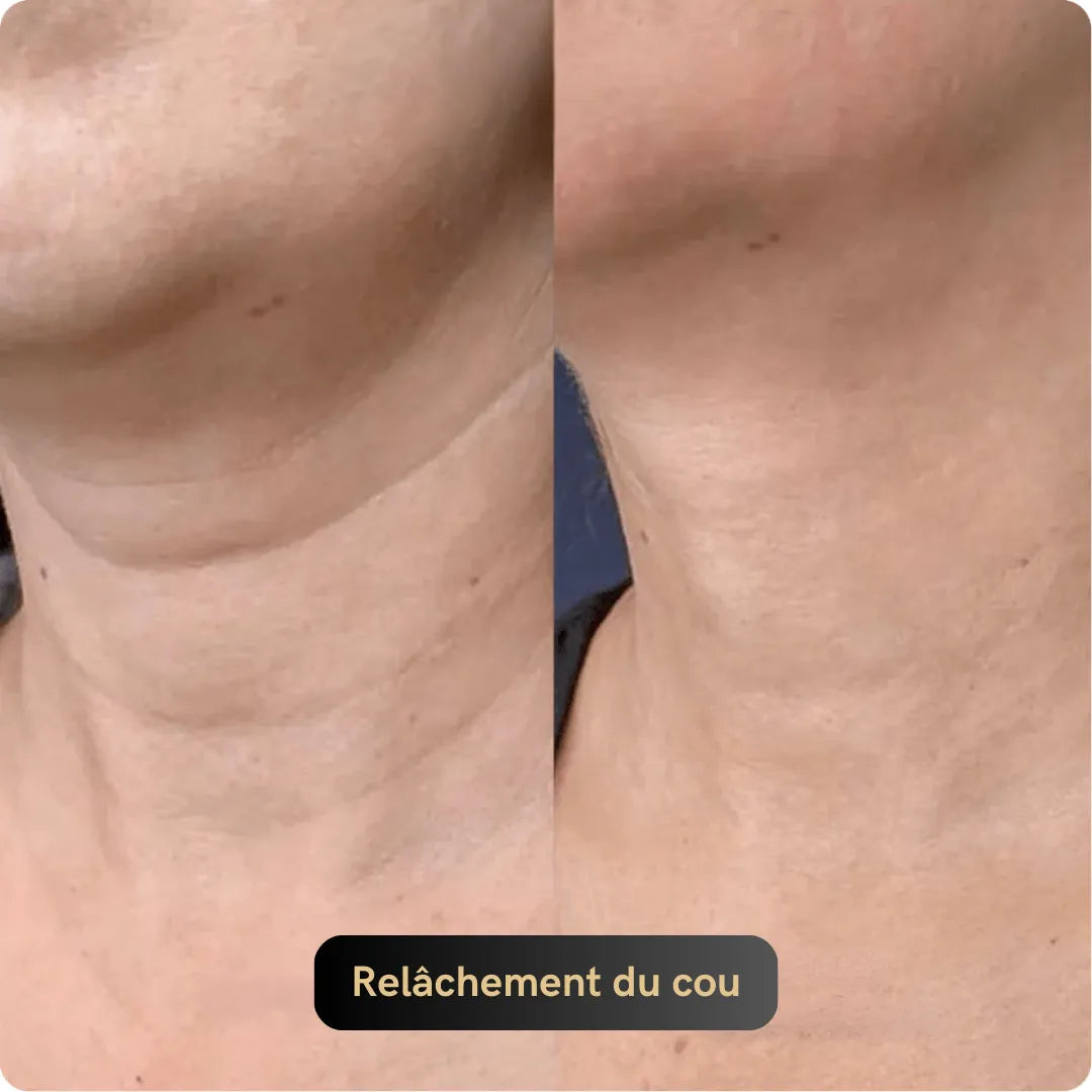 Vitagen® Système Micro-Infusion