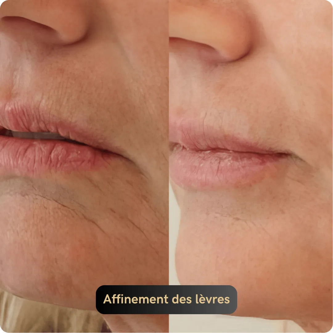 Vitagen® Système Micro-Infusion