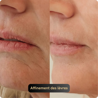 Vitagen® Système Micro-Infusion