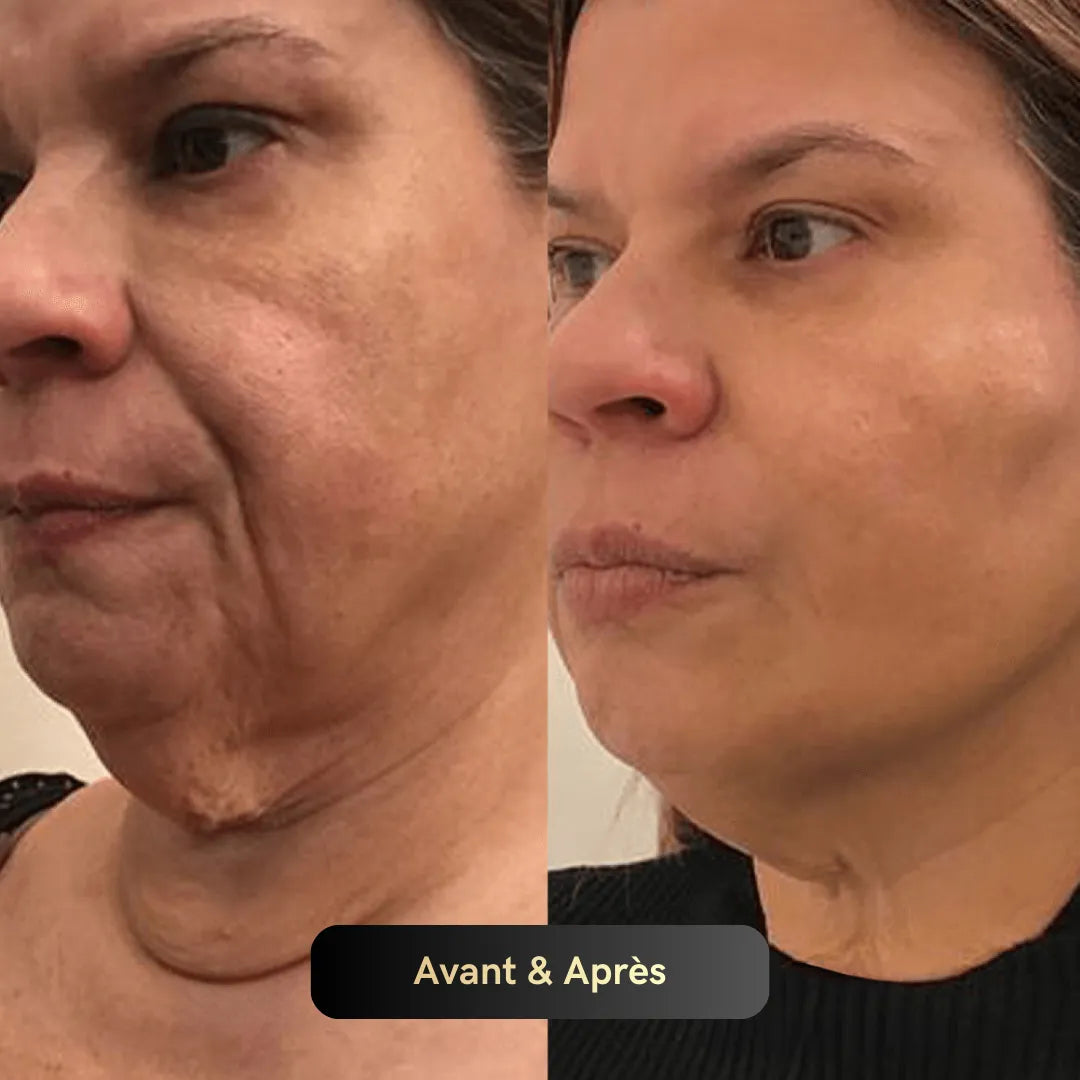 Vitagen® Système Micro-Infusion